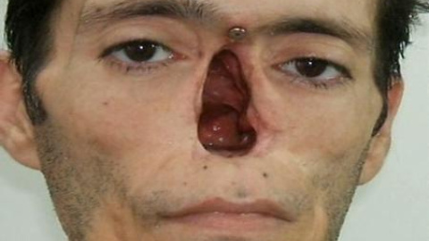 Prótesis de silicona y cera para recuperar rostros y dedos Prótesis de silicona y cera para recuperar rostros y dedos