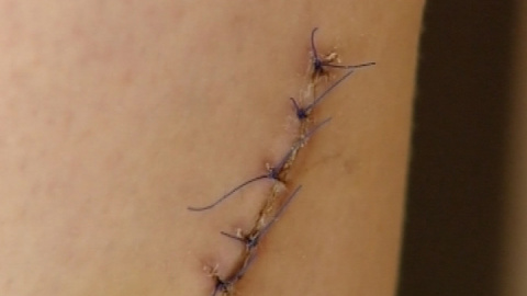 La operan de la pierna equivocada La operan de la pierna equivocada