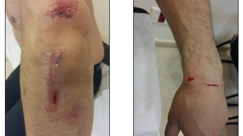 Heridas provocadas a un camarero tras una agresión homófoba y racista en Madrid./Público Heridas provocadas a un camarero tras una agresión homófoba y racista en Madrid./Público