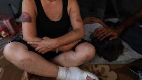 El cuerpo amoratado de una mujer tras haber sido golpeada por la Policía de Croacia. - Fotografía cortesía de ENZO TOMASIELLO El cuerpo amoratado de una mujer tras haber sido golpeada por la Policía de Croacia. - Fotografía cortesía de ENZO TOMASIELLO