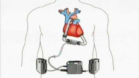 El día a día con un corazón de titanio El día a día con un corazón de titanio
