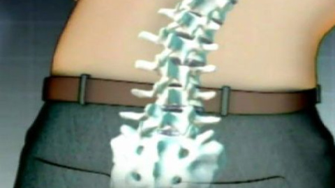 Cómo será la operación de hernia discal del rey Cómo será la operación de hernia discal del rey