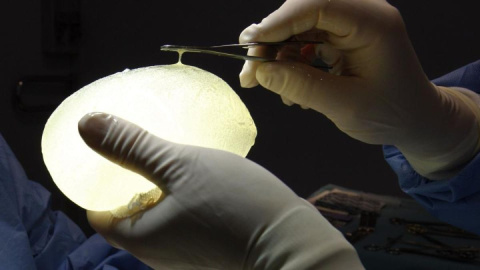 Un cirujano sujeta un implante de silicona PIP. Reuters Un cirujano sujeta un implante de silicona PIP. Reuters
