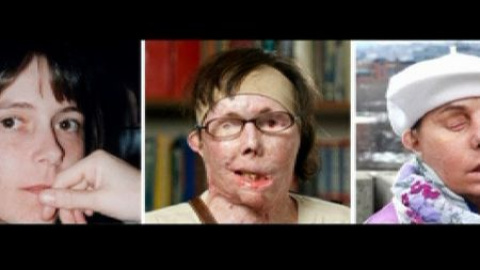 Sexto transplante completo de cara en EEUU Sexto transplante completo de cara en EEUU