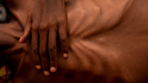 Golfi Bemonza de Bossongo, que sufre de SIDA y desnutrición aguda severa, aparece en la Clínica Pediátrica apoyada por UNICEF, en Bangui