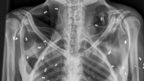 Radiografia del torso de la orangutana./EFE Radiografia del torso de la orangutana./EFE