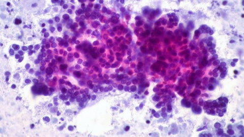 Imagen de un cáncer de páncreas. Flickr Ed Uthman Imagen de un cáncer de páncreas. Flickr Ed Uthman