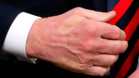 La mano de Trump marcada con los dedos de Trump. (LEAH MILLS | REUTERS) La mano de Trump marcada con los dedos de Trump. (LEAH MILLS | REUTERS)