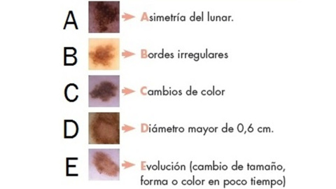 Regla del ABCDE del cáncer de piel. /IDEI Regla del ABCDE del cáncer de piel. /IDEI