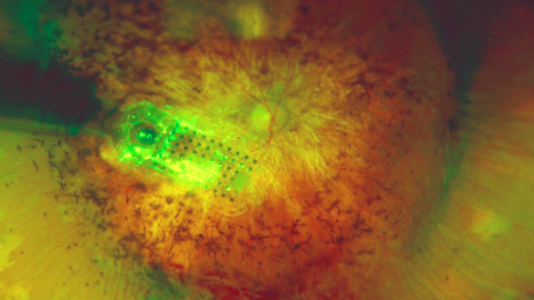 El ojo biónico, implantado en un hospital cordobés, ha devuelto parte de la visión a una mujer ciega / PUBLICO