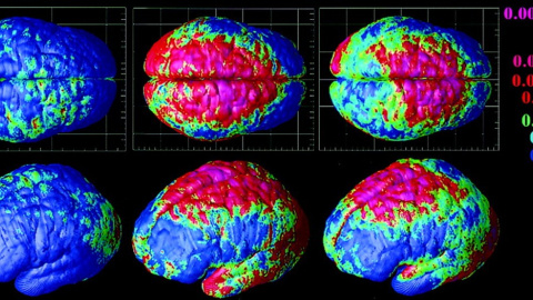 Depresión, esquizofrenia, autismo y trastorno bipolar son más similares de lo que sus síntomas indican Depresión, esquizofrenia, autismo y trastorno bipolar son más similares de lo que sus síntomas indican