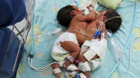 Unos gemelos siameses de tres días, en el hospital del Instituto Nacional del Niño, en Lima (Perú). Los médicos tratarán de separar sus cuerpos mediante una intervención quirúrgica.- JORGE BARTRA (REUTERS)
