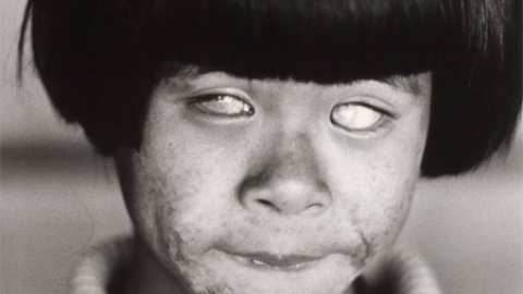 La "niña que vio la luz que brilla como mil soles" en Hiroshima, con la cara y los ojos quemados. La "niña que vio la luz que brilla como mil soles" en Hiroshima, con la cara y los ojos quemados.