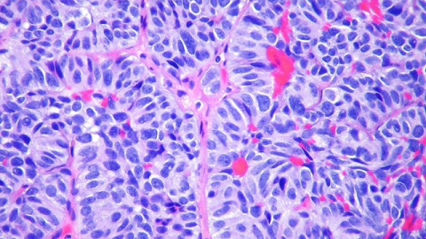 Imagen de archivo de una metástasis en el pulmón. FLICKR/PULMONARY PATHOLOGY Imagen de archivo de una metástasis en el pulmón. FLICKR/PULMONARY PATHOLOGY