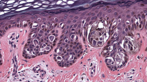 El melanoma es, junto al cáncer de colon, una enfermedad que se podría combatir empleando esta nueva célula / Edgepath El melanoma es, junto al cáncer de colon, una enfermedad que se podría combatir empleando esta nueva célula / Edgepath