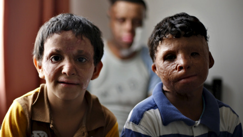 Hamza Mohammed (I), un yemení de 6 años, Saleim Ahmed (D), de 12 años y Waa'el Sameer (C), de 23 años, que resultaron heridos hace unos cuatro años durante la violencia en su país, esperan a ser operados por cirujanos plásticos en un nuevo 
