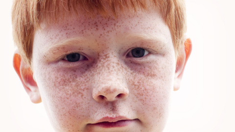 La fascinación provocada por el pelo rojizo y las pecas no siempre es positiva. Muchos niños pelirrojos sufren acoso debido a su color de pelo o de piel.
