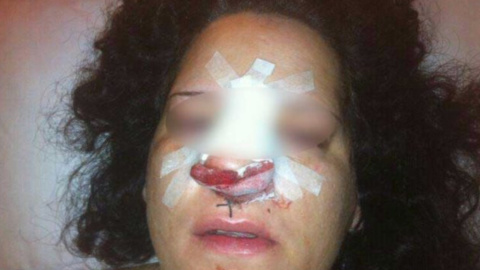 Laura (nombre ficticio) tras haber recibido la intervención por la grave fractura de nariz. Laura (nombre ficticio) tras haber recibido la intervención por la grave fractura de nariz.