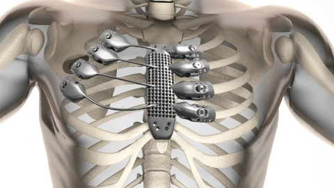 Implantan una caja torácica y un esternón elaborados con una impresora 3D Implantan una caja torácica y un esternón elaborados con una impresora 3D