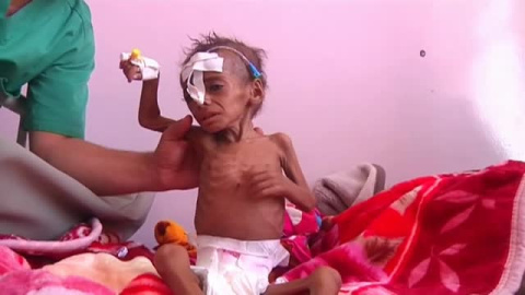 Yemen se expone a una brutal crisis humanitaria por hambre Yemen se expone a una brutal crisis humanitaria por hambre