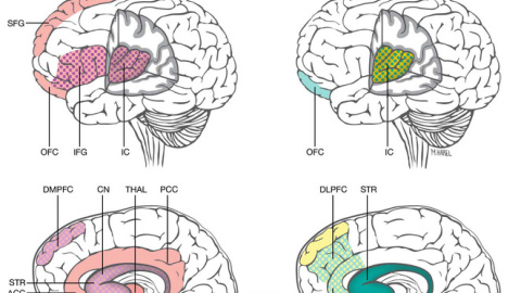 Diferencias y similitudes encontradas en las resonancias en áreas del cerebro asociadas a la depresión postparto, ansiedad y depresión mayor / Maayan Harel