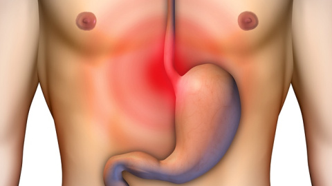 Evitar y controlar la acidez y el reflujo, medida de prevención del cáncer de esófago. Evitar y controlar la acidez y el reflujo, medida de prevención del cáncer de esófago.