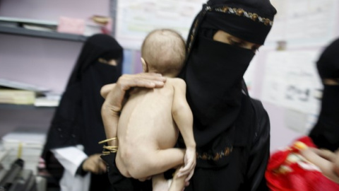 Una dona té en braços un nen que pateix desnutrició. REUTERS / Khaled Abdulah