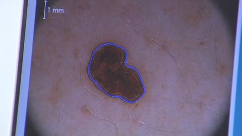 Moderna anuncia para 2030 una vacuna contra el cáncer de piel Moderna anuncia para 2030 una vacuna contra el cáncer de piel