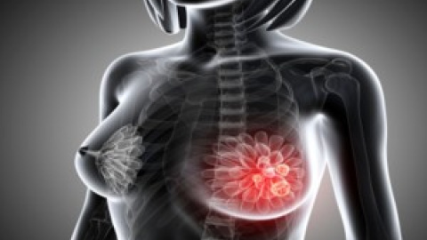 Investigan nueva dianas terapéuticas para tratar el cáncer de mama
