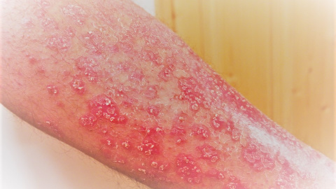 La psoriasis es una enfermedad inflamatoria cutánea de carácter autoinmune que provoca el desprendimiento e infección de la piel causando dolor e hinchazón
