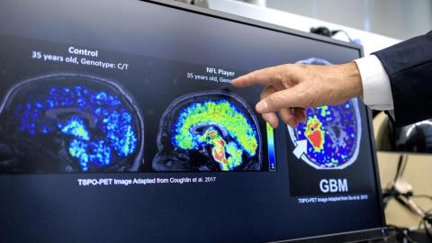 Imagen de una radiografía cerebral en un paciente de alzhéimer.