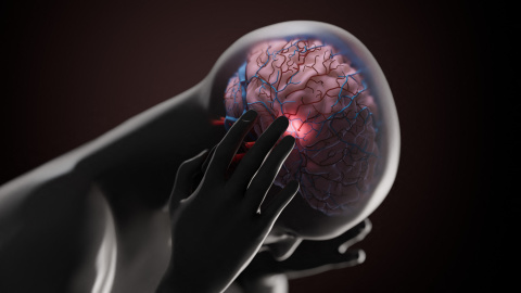 Ilustración conceptual de una migraña.