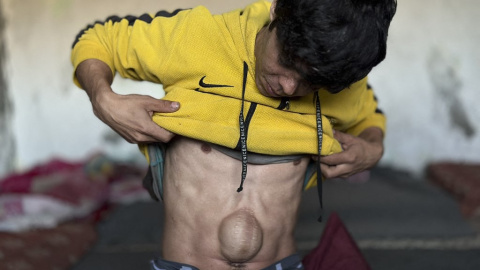 Mohammed Abu Odeh,  ingeniero electrónico y practicante de parkour de Jan Yunis, se levanta la camiseta para mostrar las cicatrices de la operación que necesitó tras una ofensiva terrestre israelí (10/02/2026)