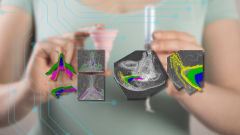 Fotomontaje con imágenes de la reconstrucción tridimensional de la red nerviosa del clítoris. Fotomontaje con imágenes de la reconstrucción tridimensional de la red nerviosa del clítoris.