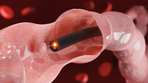 Endoscopio en el interior de intestino.