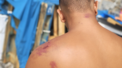 Un hombre con lesiones en la espalda en el campamento de Naves del Tarajal. Un hombre con lesiones en la espalda en el campamento de Naves del Tarajal.