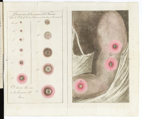 Brazo con pústulas de viruela. Wikimedia Commons