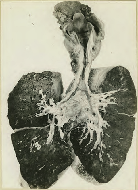 Primera Guerra Mundial: Unos pulmones muestran una estenosis en la tráquea tras la inhalación de gas mostaza. Foto realizada el 12 de enero de 1919. Autor desconocido. Wikimedia Commons