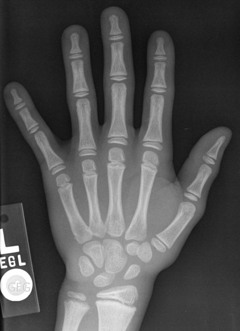 Radiografía de una mano de un niño de 8 años.Bonepit.com / Wikimedia Commons
Los rayos X atraviesan en mayor o menor medida el objeto que se ponga en su camino y llegan a una placa fotográfica. Esta placa está formada por ciertos compu
Radiografía de una mano de un niño de 8 años.Bonepit.com / Wikimedia Commons
Los rayos X atraviesan en mayor o menor medida el objeto que se ponga en su camino y llegan a una placa fotográfica. Esta placa está formada por ciertos compu