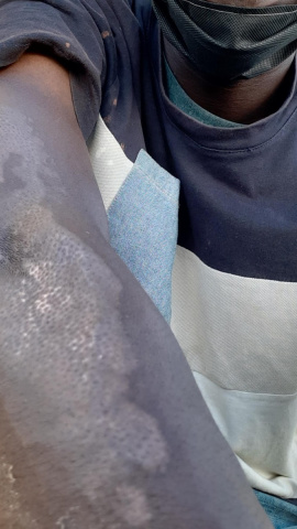 Lamine Diakite muestra las quemaduras en sus brazos por el incendio de su chabola, en Lepe. ASNUCI Lamine Diakite muestra las quemaduras en sus brazos por el incendio de su chabola, en Lepe. ASNUCI