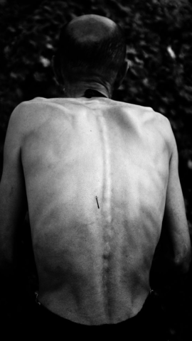 Un hombre, enfermo de cáncer, recién llegado a Lesbos.