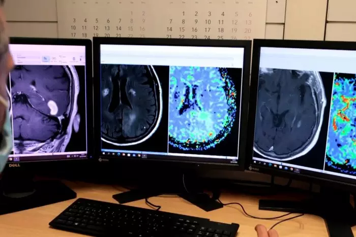 Milloren el diagnòstic de tumors cerebrals gràcies a una eina basada en la IA creada per investigadors catalans