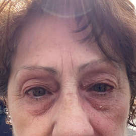 Detalle de los ojos de Teresa Pantoja tras sufrir el ataque con gas pimienta el pasado mes de enero en Sevilla.