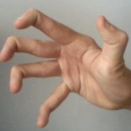 
 Muchas personas con fibromialgia tienen hipermovilidad (doble articulación). MatthewThomasWxm/Wikimedia Commons, CC BY-SA