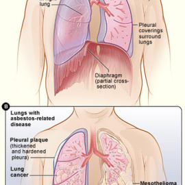 
 Los efectos del amianto en los pulmones. Imagen: Wikipedia
