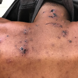 Marcas de tortura en uno de los detenidos por el Ejército brasileño en el caso de la Sala Roja. DEFENSORÍA PÚBLICO DEL ESTADO DE RÍO DE JANEIRO.