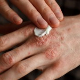 Un futuro libre de psoriasis es (casi) posible