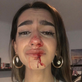 Eva muestra sus heridas tras la agresión tránsfoba. - Twitter de Eva
