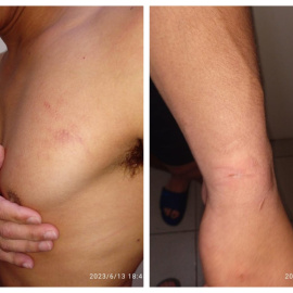 Imágenes de las marcas de la presunta agresión policial denunciada por Remigio tras su primer intento de expulsión.