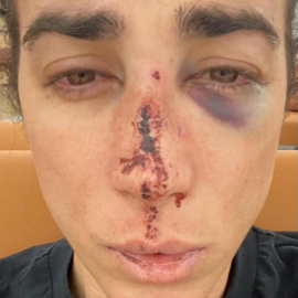 Divino mostrando sus heridas en su perfil de Instagram